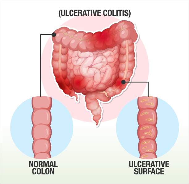 Crohn’s disease and ulcerative colitis (IBD)
