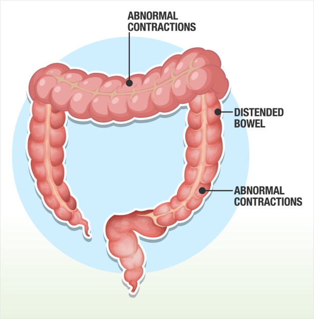 Irritable bowel syndrome (IBS)