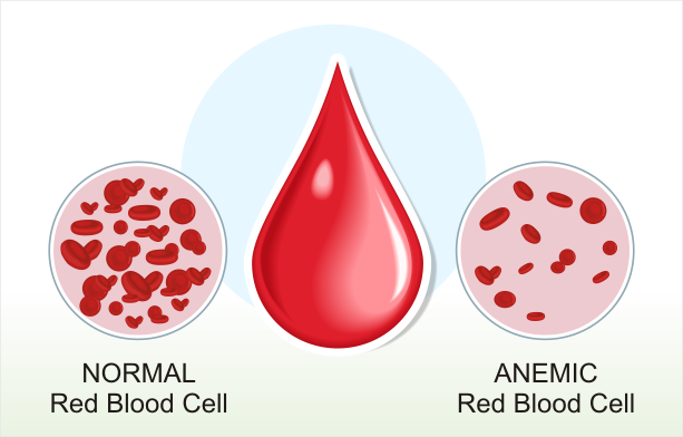 Anemia