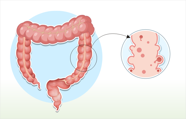 Diverticulosis