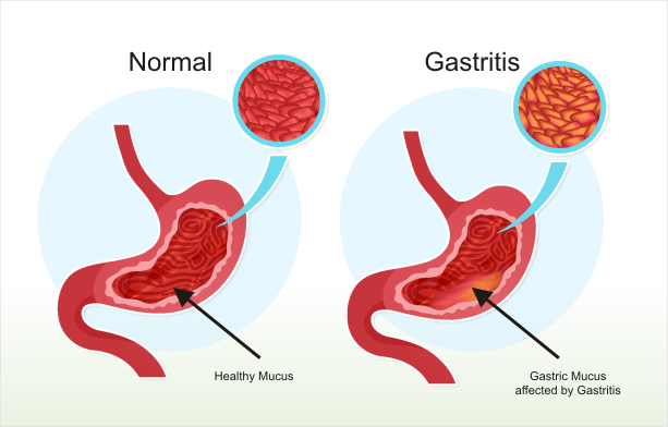 Gastritis