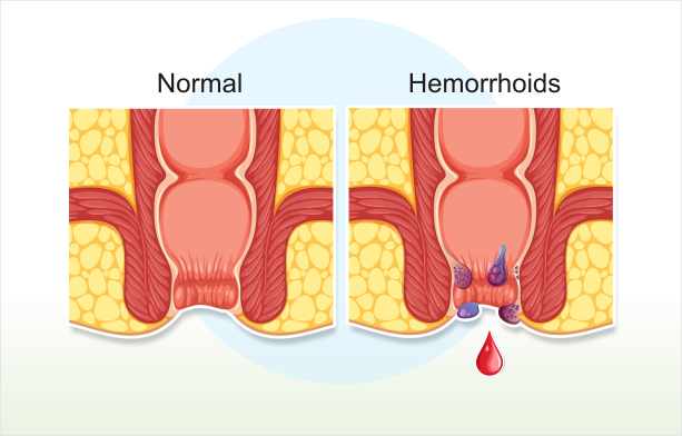 Hemorrhoids