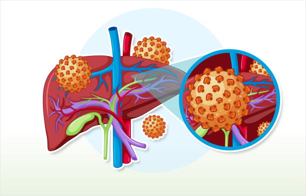 Hepatitis