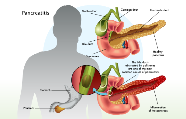 Pancreatitis